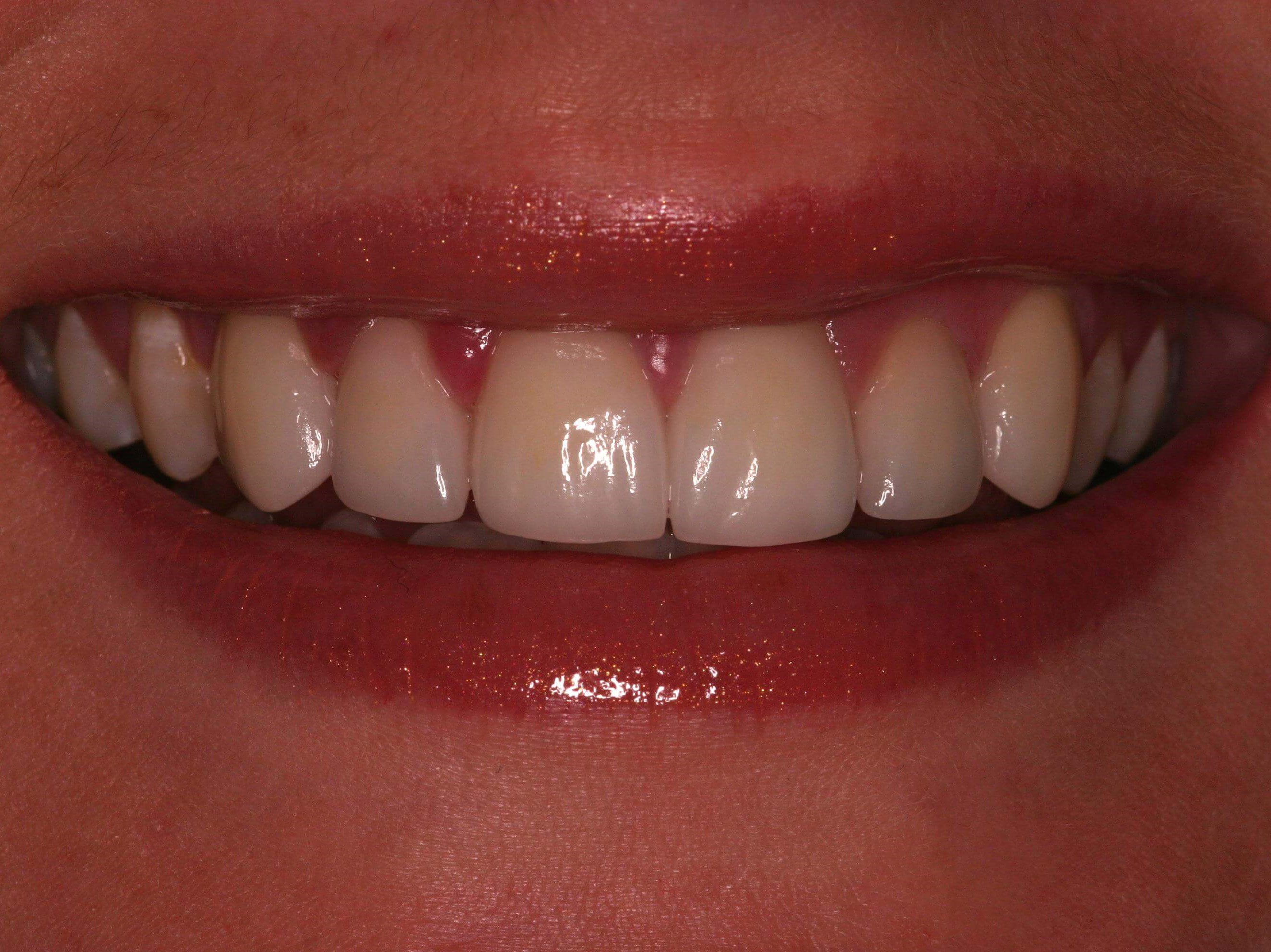 Smile Before After
