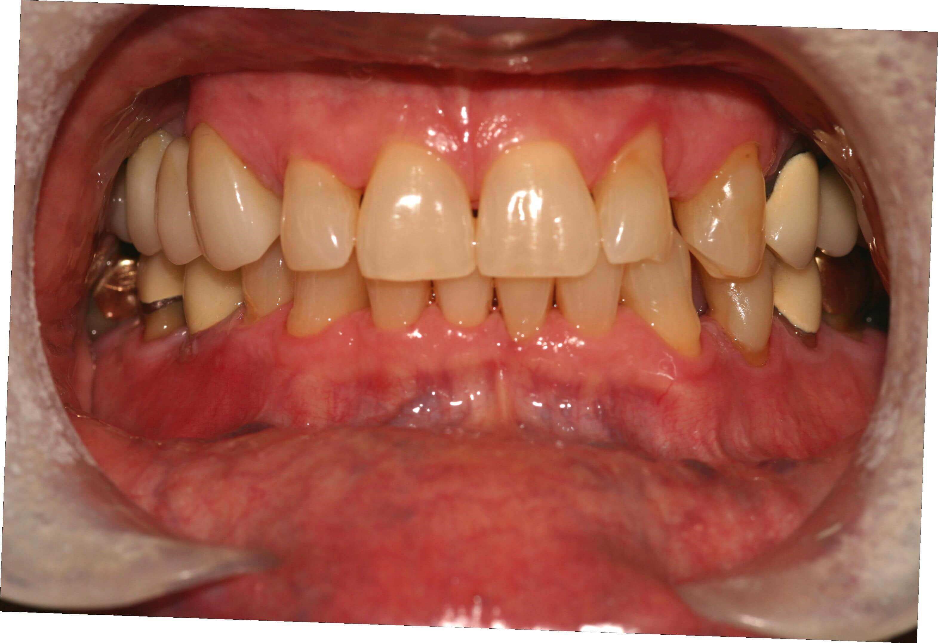 Smile Makeover Before