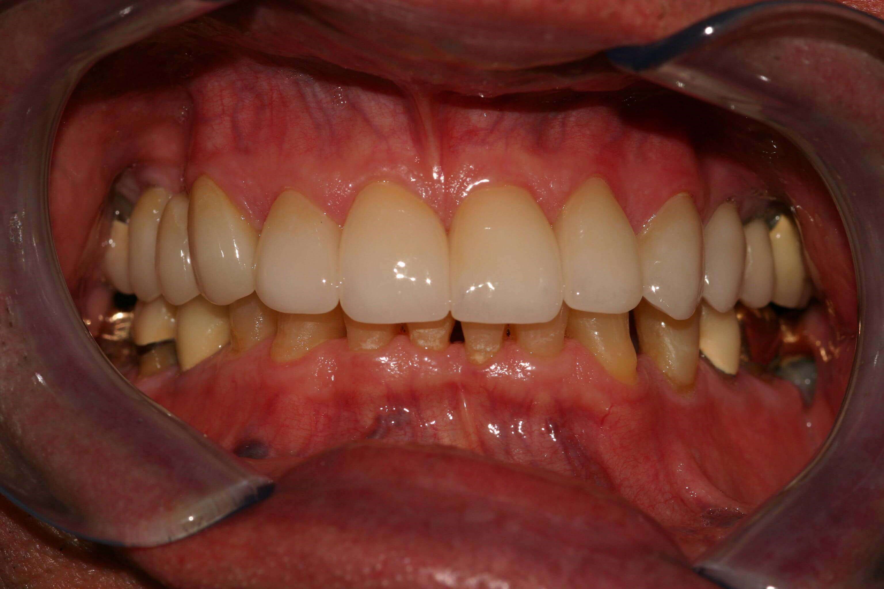 Smile Makeover After