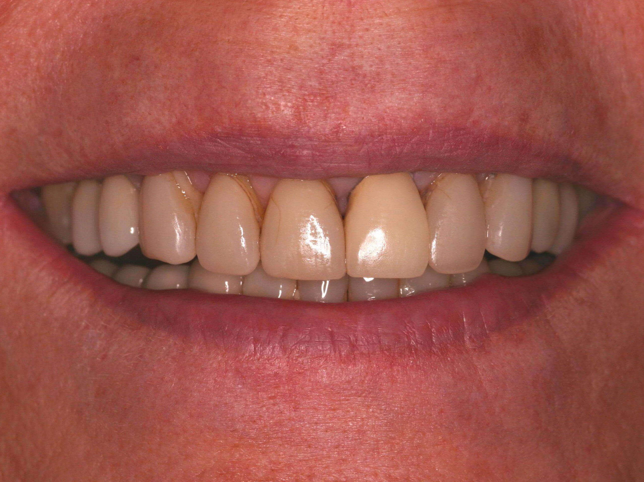Older Crowns Need Replacement Before
