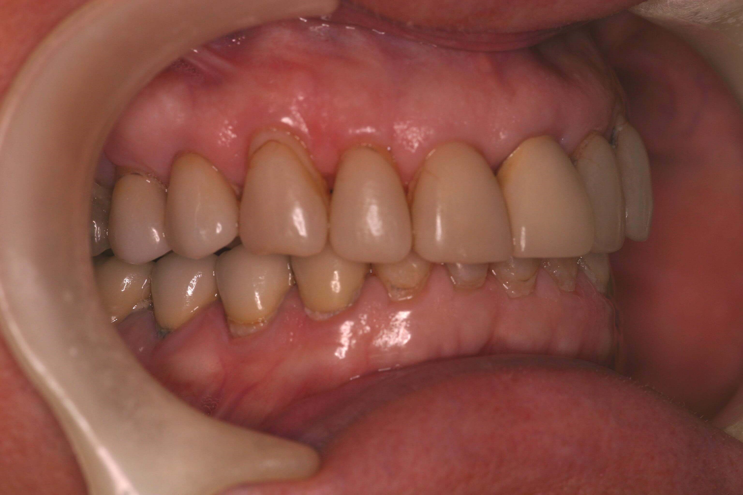 Right Side Before and After Right Bite Before