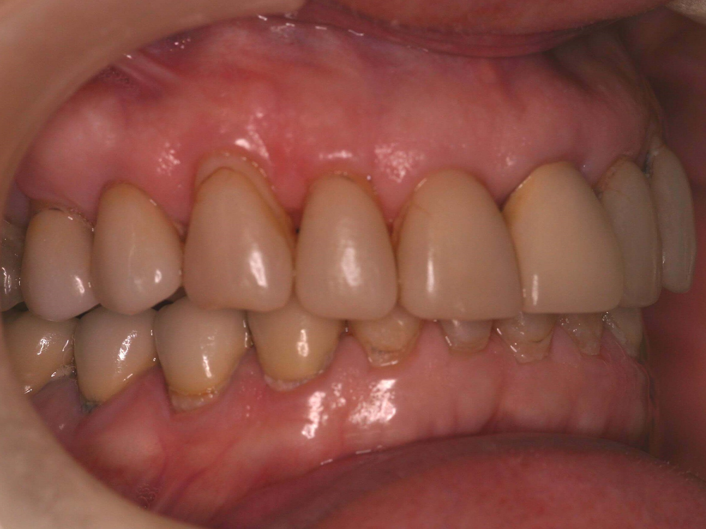 Right Side Before and After Right Bite Before