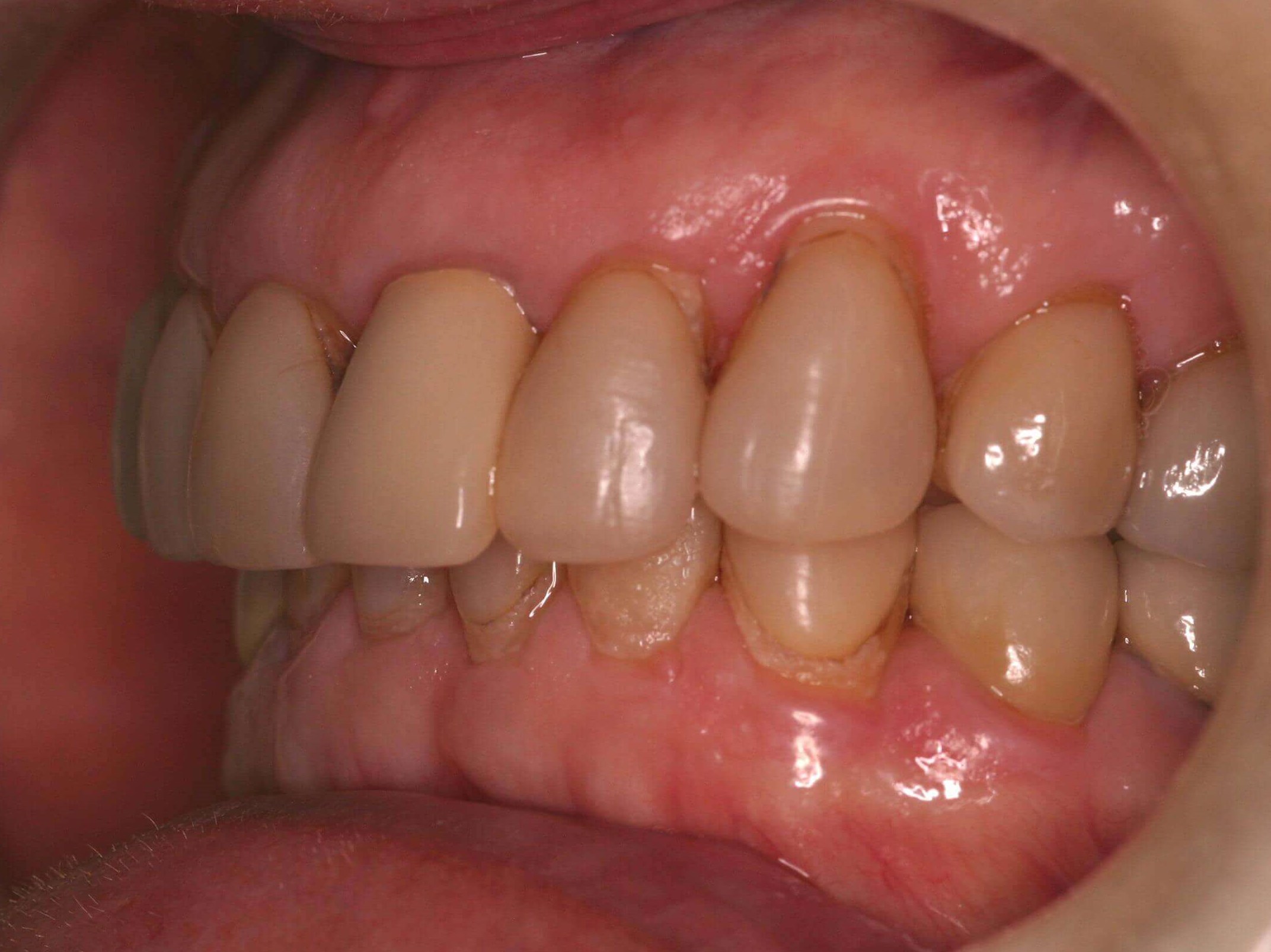Left Side Before