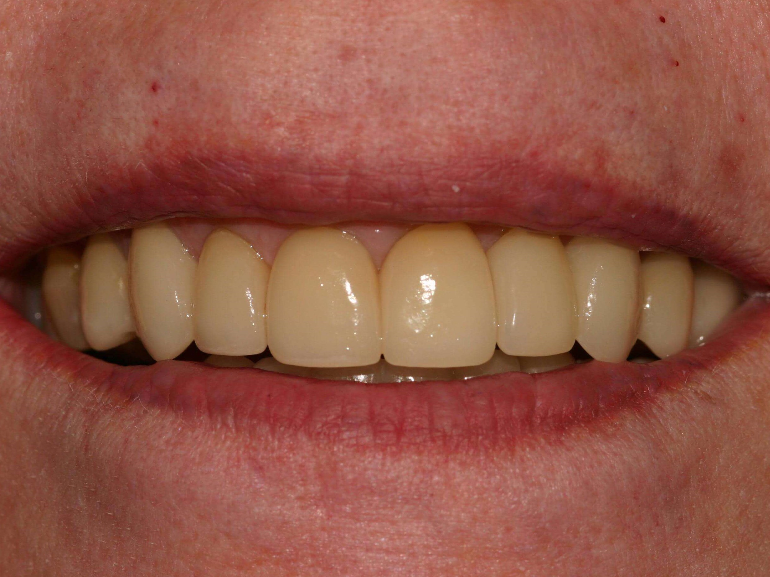Older Crowns Need Replacement After