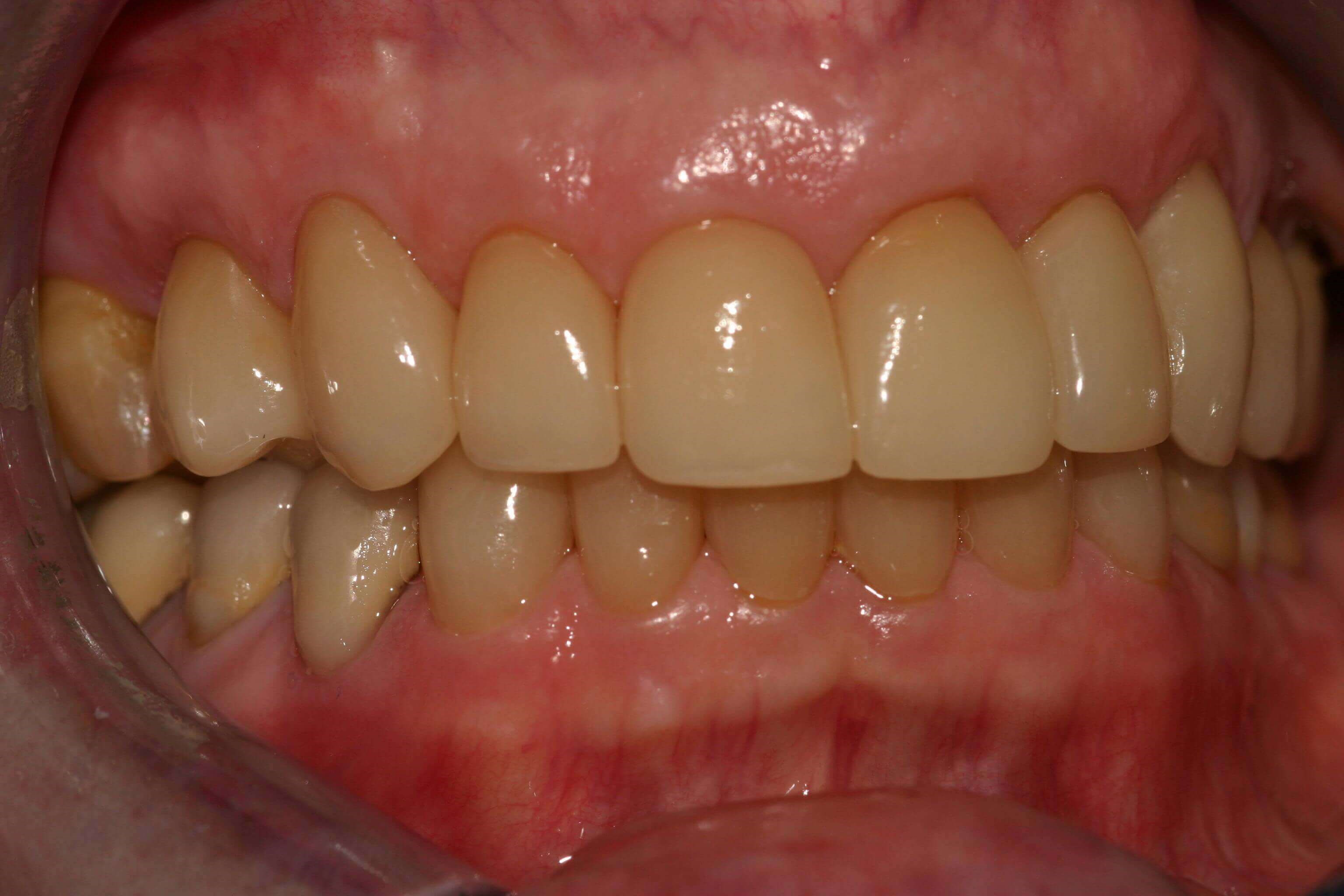 Right Side Before and After Right Bite After