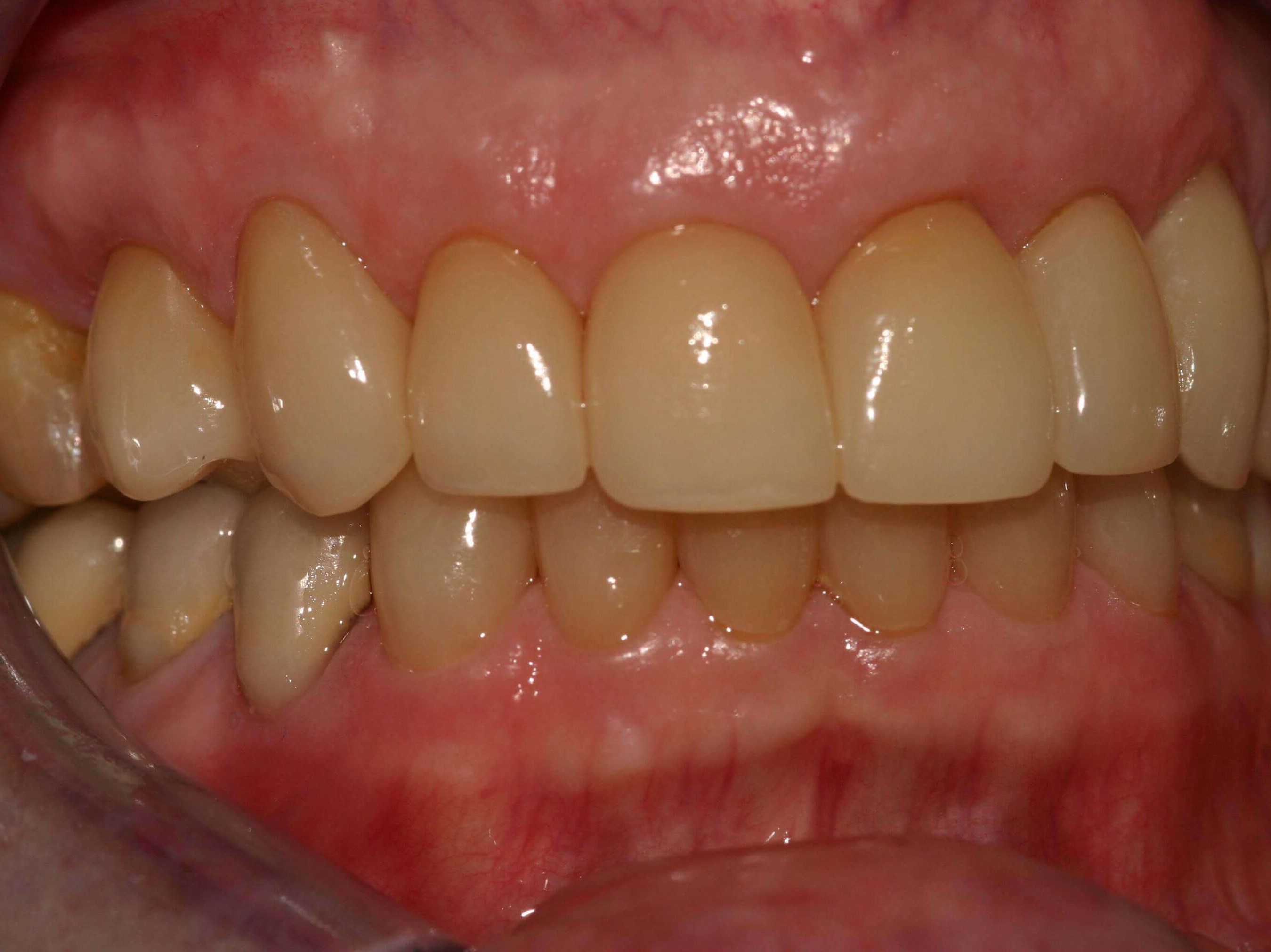 Right Side Before and After Right Bite After