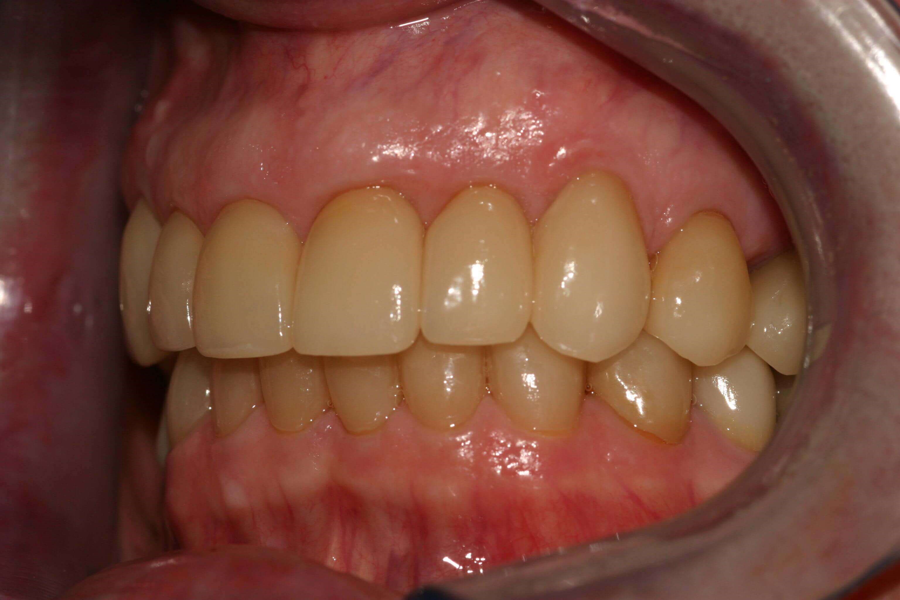 Left Side After