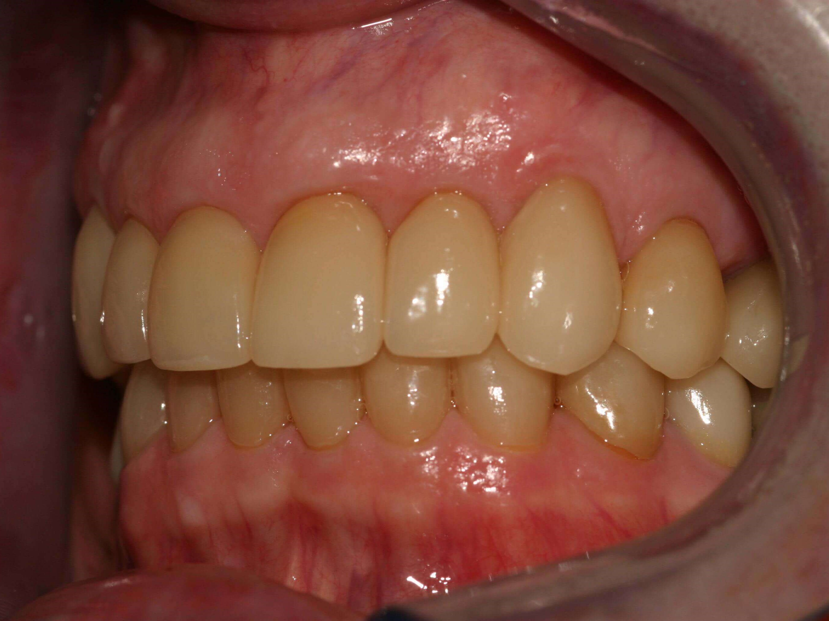 Left Side After