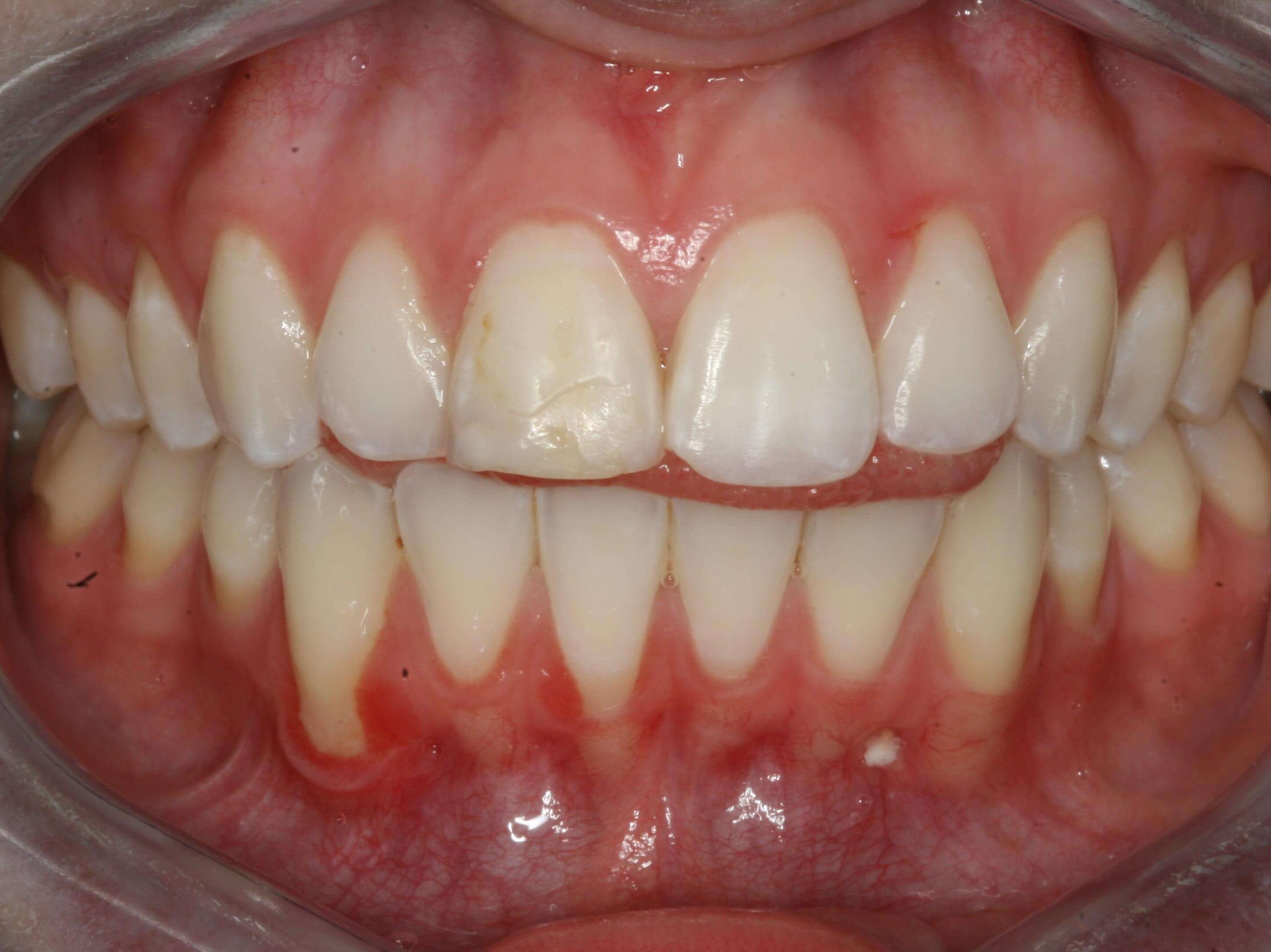 Worn Discolored Teeth Makeover Before