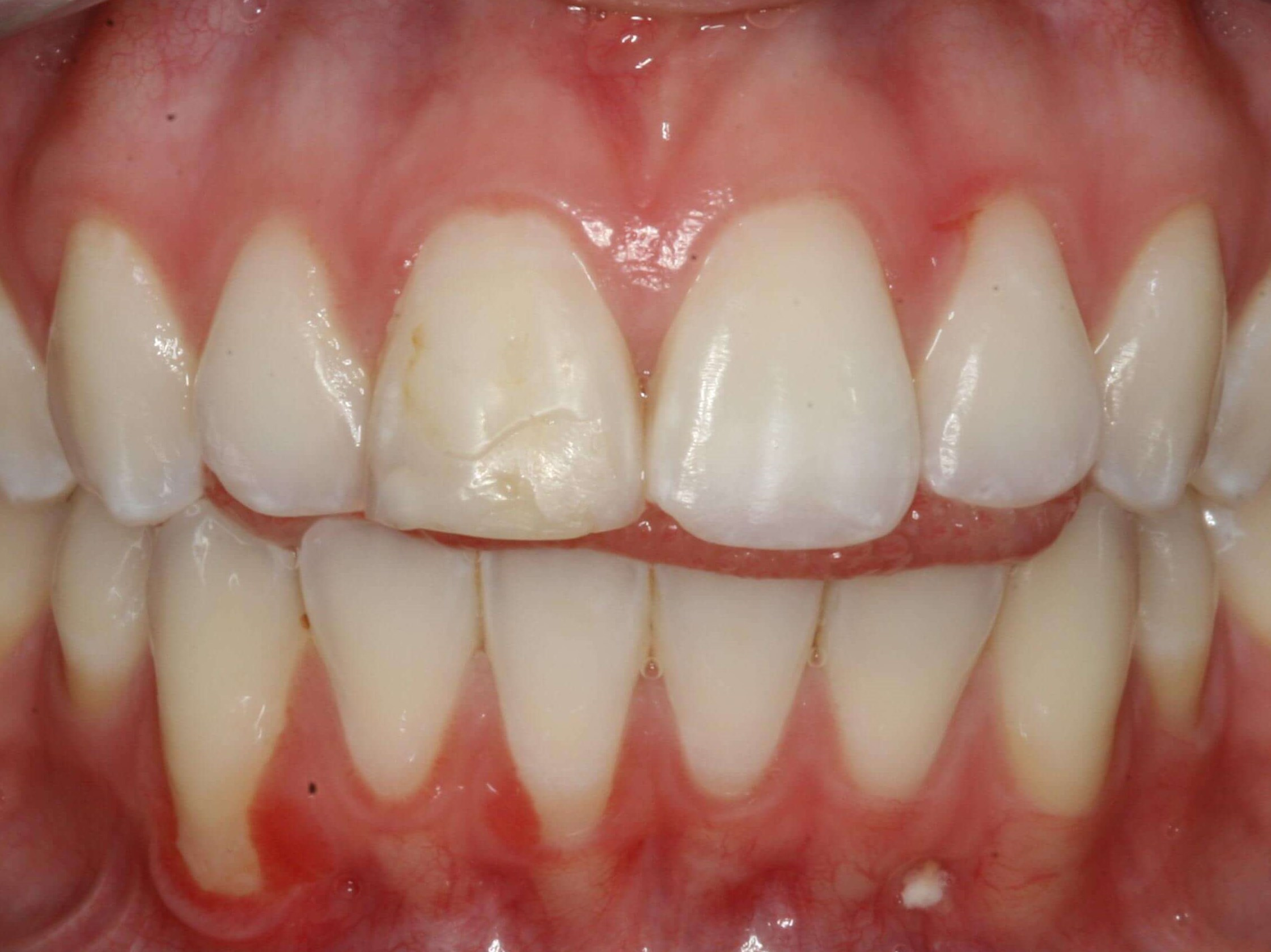 Temporary Provisional Teeth Before