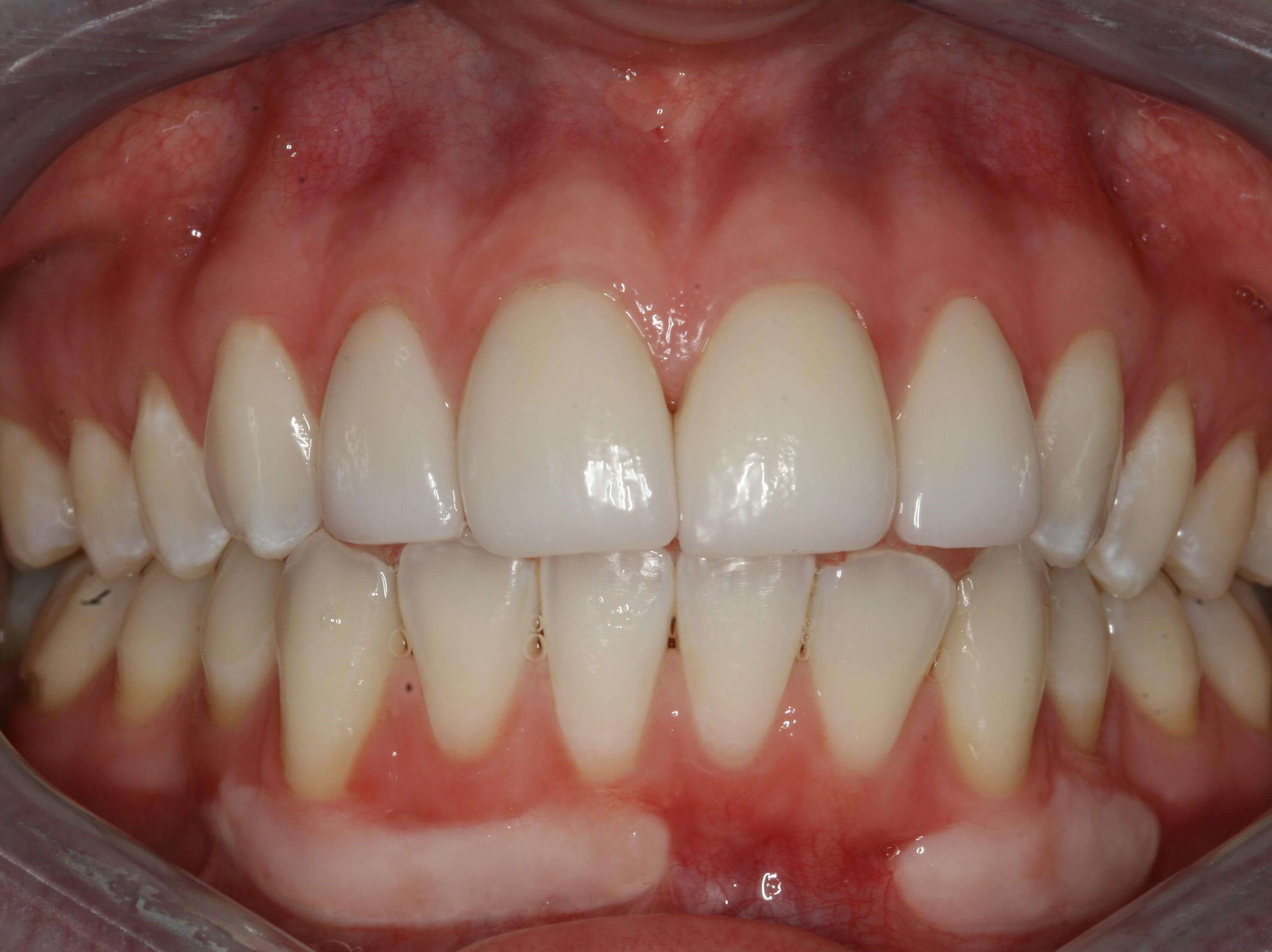 Worn Discolored Teeth Makeover After