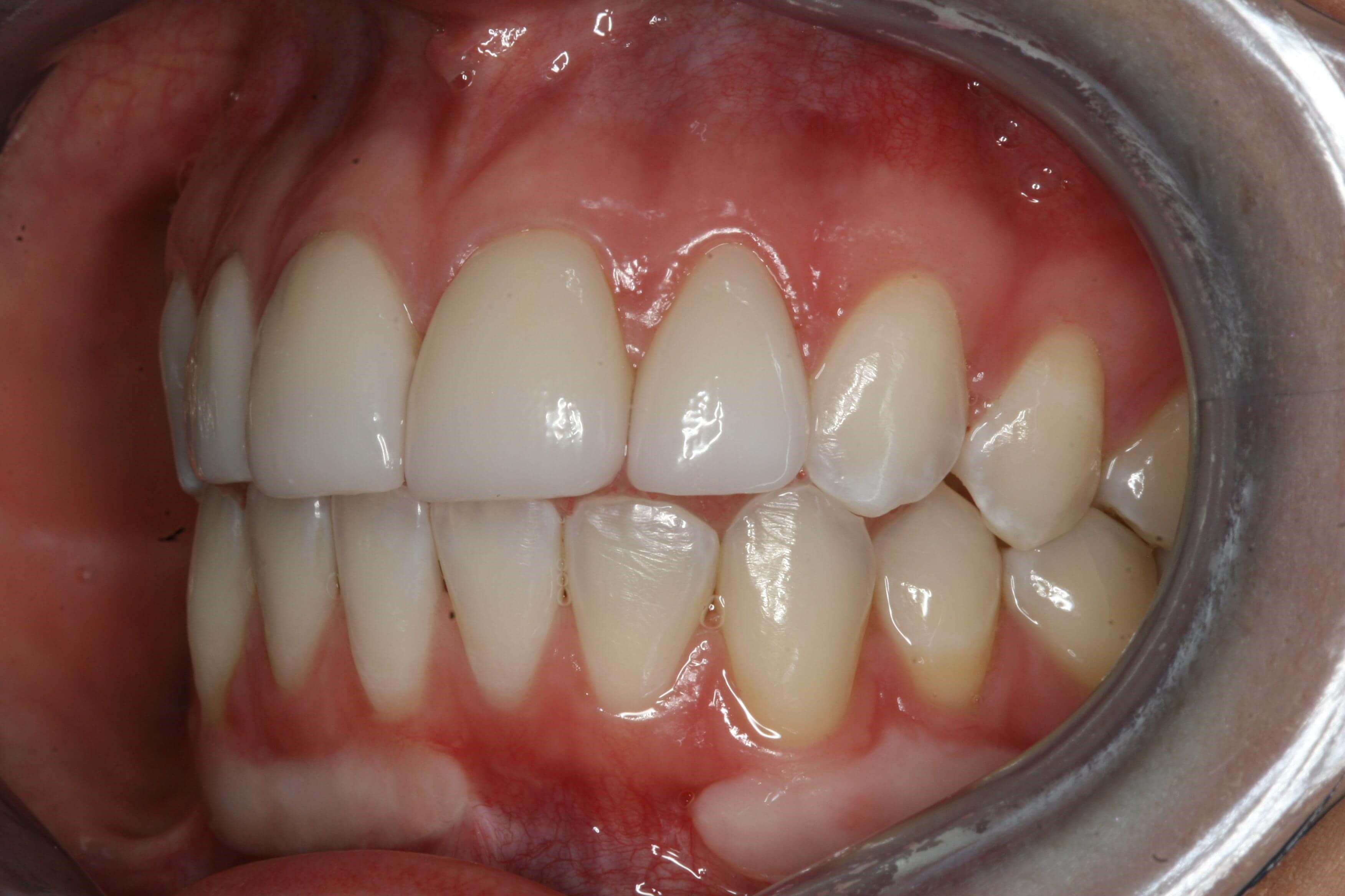 Left Side Before and After After