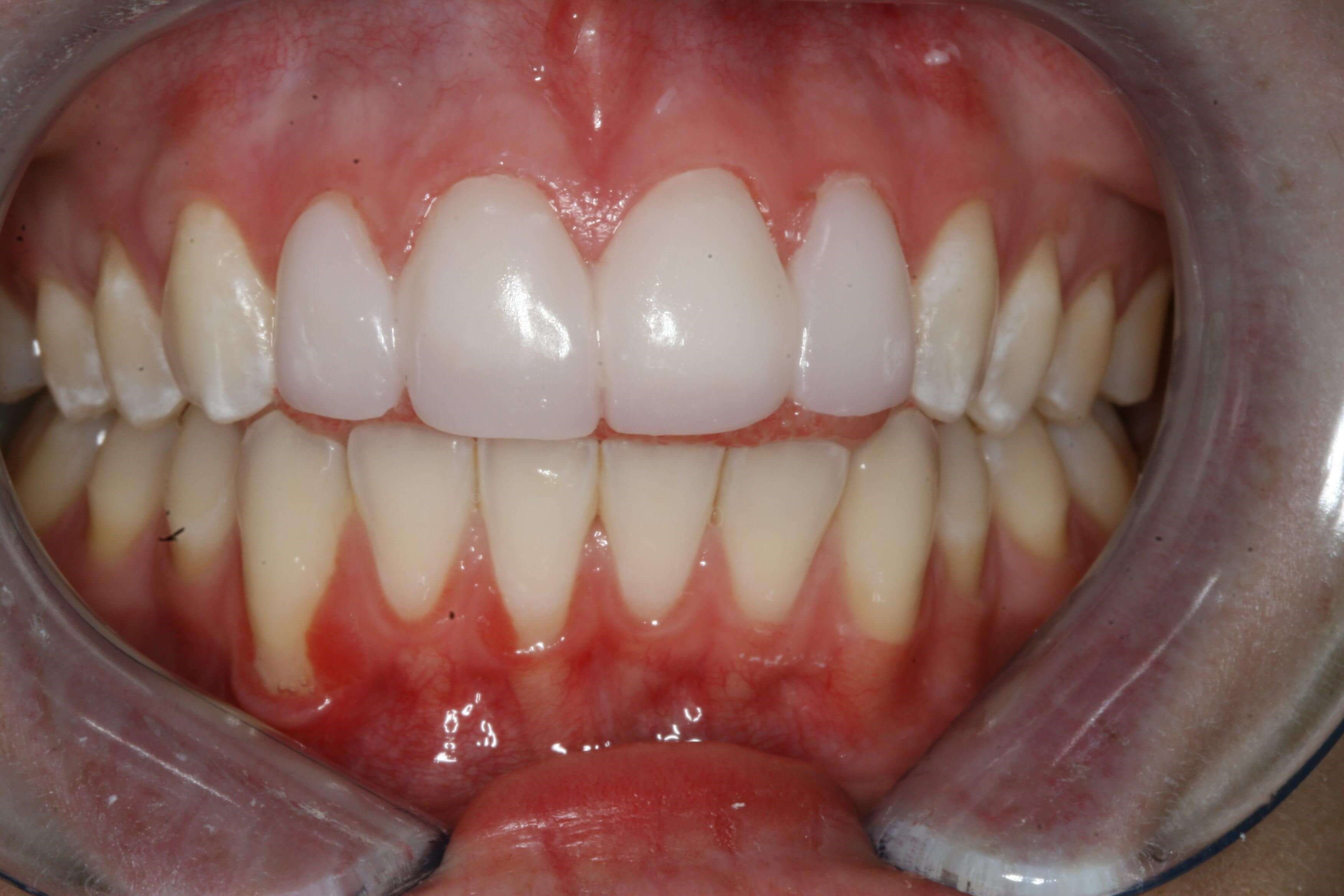 Temporary Provisional Teeth After