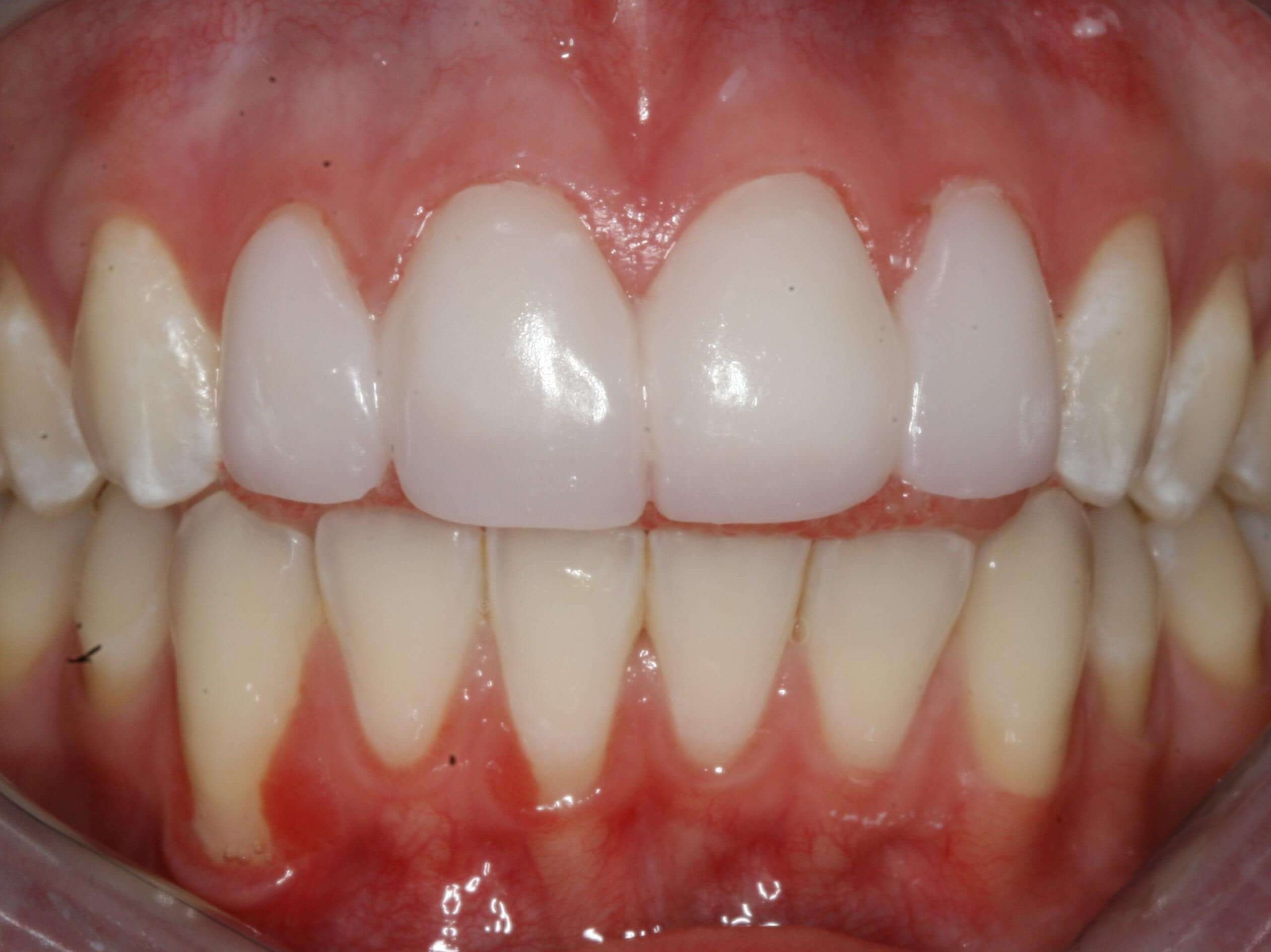 Temporary Provisional Teeth After