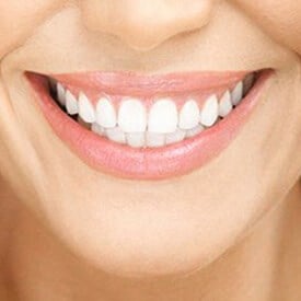 Home/Office Teeth Whitening